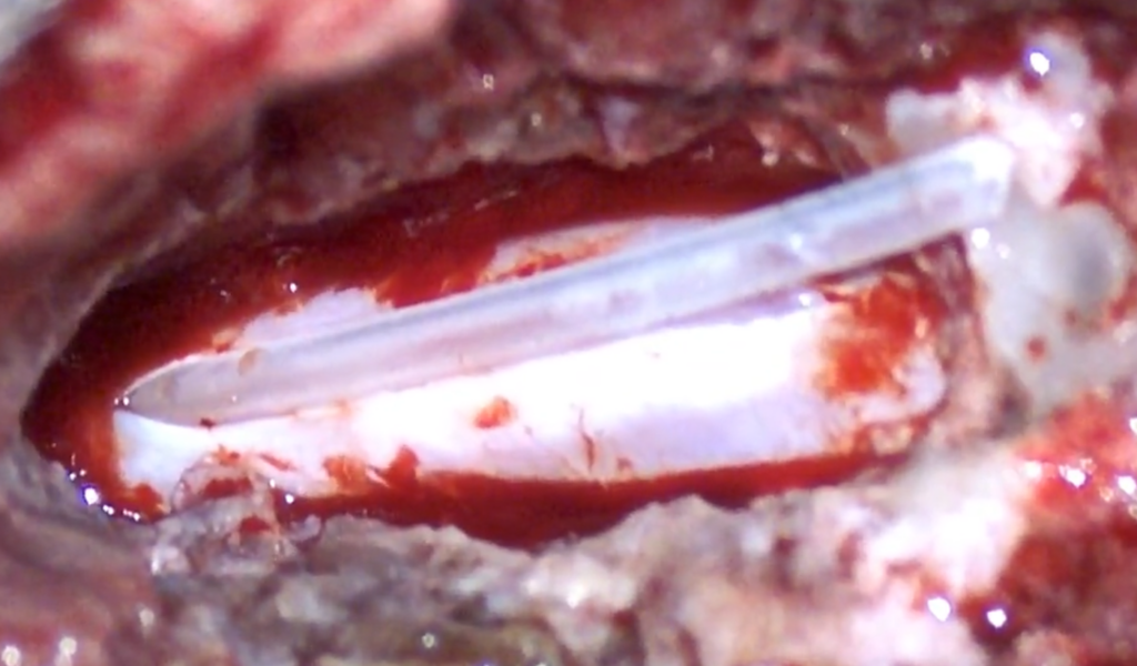 A subarachnoid shunt in place on the dorsal aspect of the cord