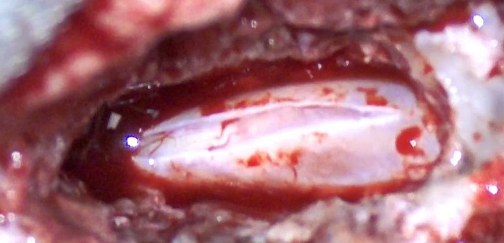 A linear incision is made in the dorsal dura mater (durotomy)