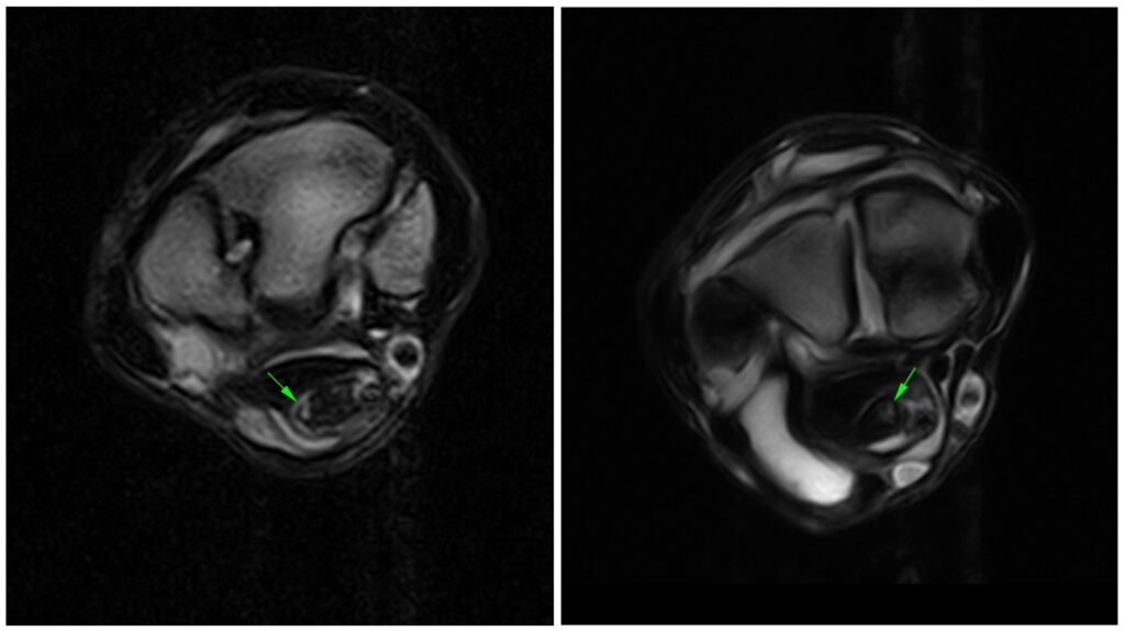 Figure 2: Transverse T2E FSE iNAV and T2W FSE iNAV PAICE sequences at the level of the carpus showing increased signal intensity of the SDFT, enlargement of the tendon and loss of definition.