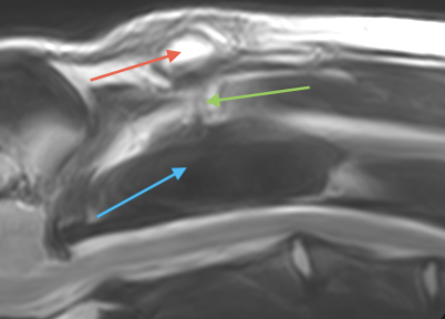 A dermoid sinus in a young Rhodesian Ridgeback. MRI T2W sagittal image of the cranial cervical vertebral column.