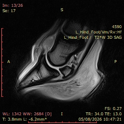 Fig 5: LH T2* 3D GRE SAG. Significant fluid distension within the DIP joint.