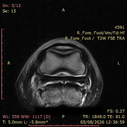 Fig 1: – RF T2 FSE TRA. Shallow dorsal margin irregularity of both lobes of the DDFT within the proximal recess of the navicular bursa & increased tissue bridging the mid to axial aspect of both lobes of the DDFT & the CSL.