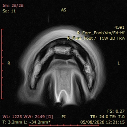 Fig 2: RF T1 3D GRE TRA. Distal to the navicular bone, abnormal linear increased signal intensity within the medial lobe of the DDFT which continues to it’s insertion onto P3.
