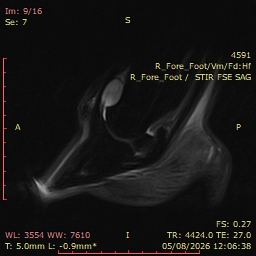 Fig 3: RF STIR SAG. Diffuse moderately increased signal intensity throughout the mid to palmar aspect of the navicular spongiosa. Moderate fluid distension of the DIP joint & moderate peri-articular modelling of the dorsodistal aspect of P2