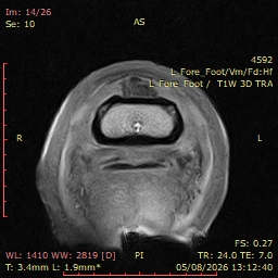Fig 4: LF T1 3D GRE TRA.
Enlargement of the dorsal margin of the DDFT within the proximal recess of the navicular bursa.