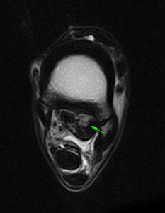Figure 1(a): Transverse T2W FSE iNAV - showing the lesion of the lateral lobe of the proximal suspensory ligament.