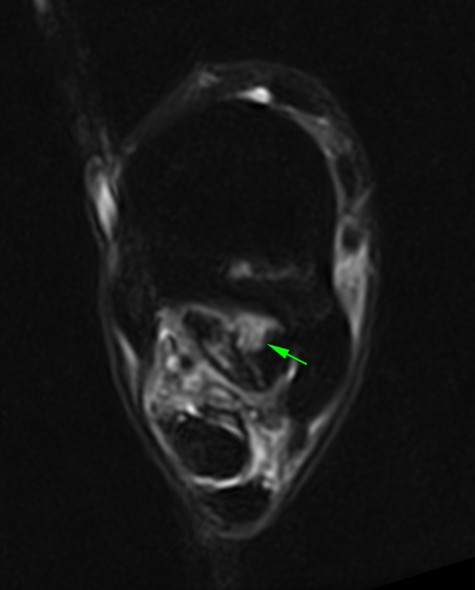 Figure 1(b): STIR FSE iNAV - showing the lesion of the lateral lobe of the proximal suspensory ligament.