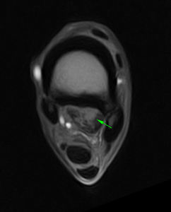 Figure 1(c): T1W GRE FAST - showing the lesion of the lateral lobe of the proximal suspensory ligament.
