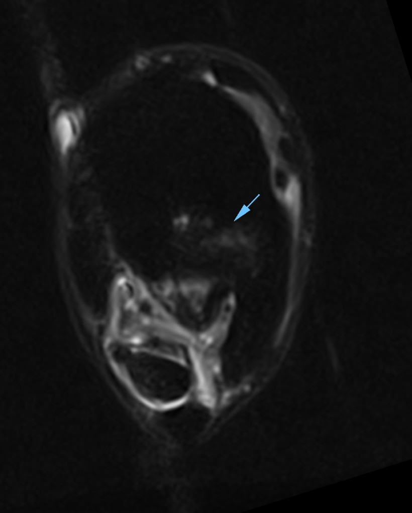 Figure 2: Transverse STIR FSE iNAV sequence showing  bone edema like signal at the proximal aspect of the third metatarsal bone.